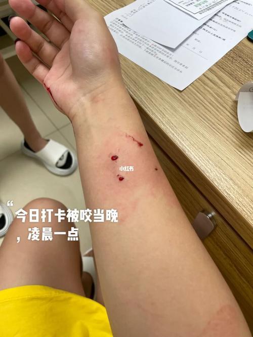 打狂犬疫苗期间又被猫抓伤了怎么办(打狂犬疫苗期间又被猫抓伤了怎么办啊)